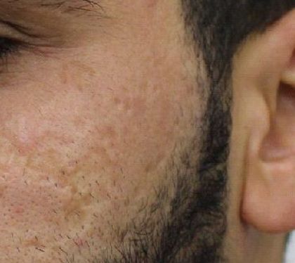 Nanofat Acne Scar Treatment - Before