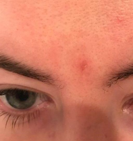  Steroid Injection for Acne Scar Treatment - After