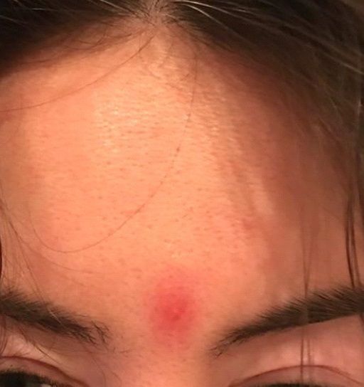  Steroid Injection for Acne Scar Treatment - Before