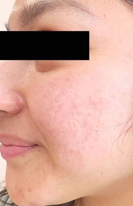 Radiofrequency Reaction VST for Acne Scar Treatment - After
