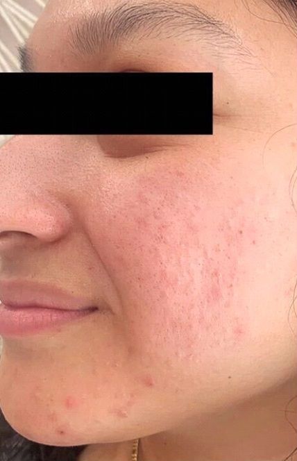 Radiofrequency Reaction VST for Acne Scar Treatment - Before