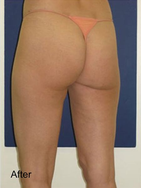 Viora Reaction For Front Thighs Cellulite - After