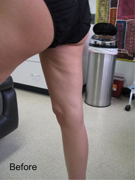 Viora Reaction For Front Thighs Cellulite - Before