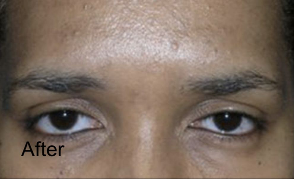 Botox for Frown Lines in Male  After