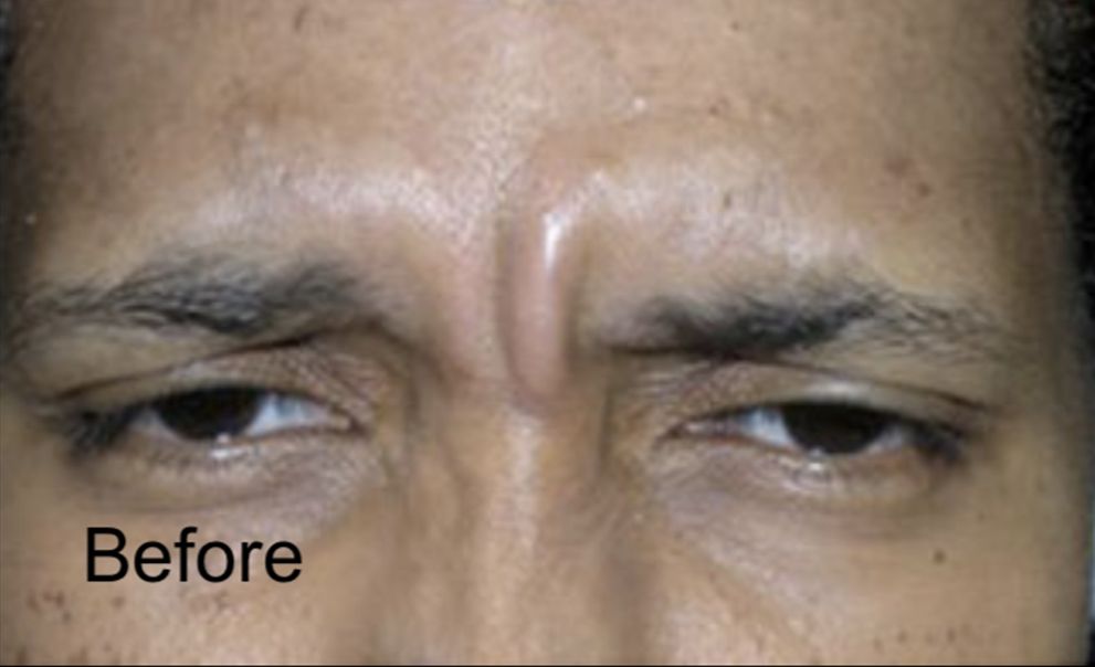 Botox for Frown Lines in Male  Before