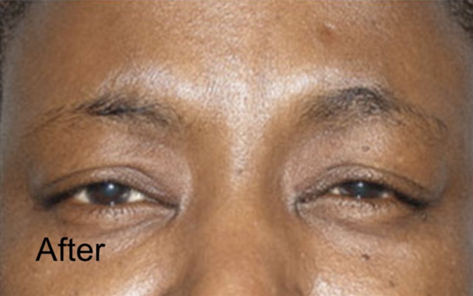 Botox for Forehead Wrinkles in Men After