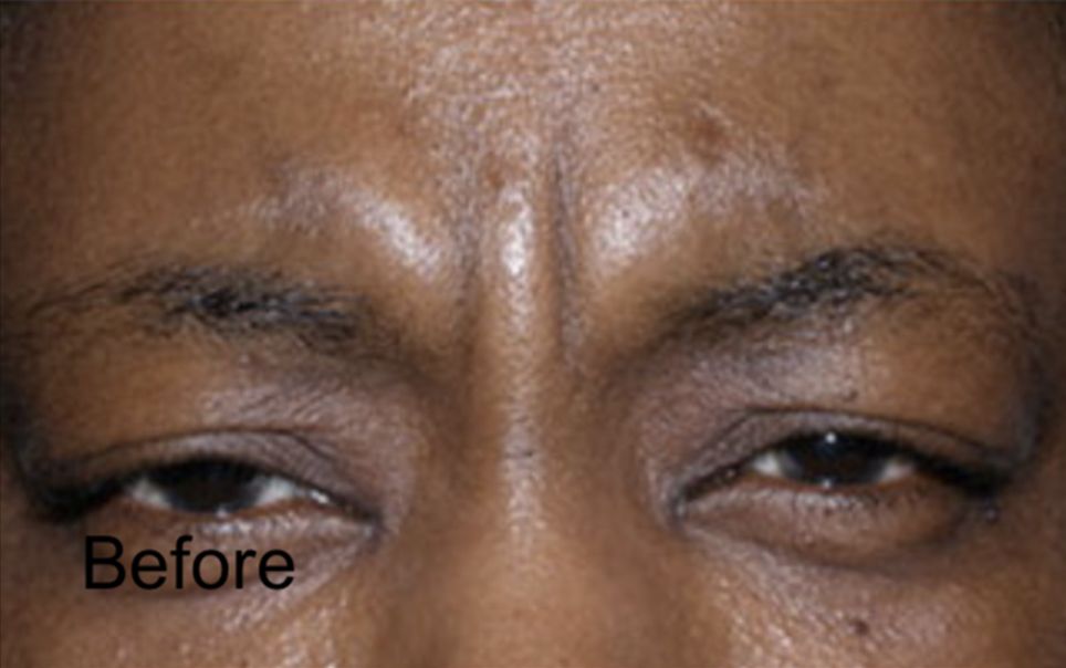 Botox for Forehead Wrinkles in Men Before