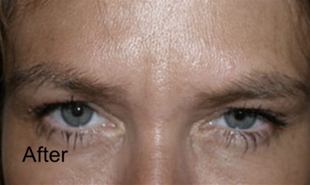 Botox to Get Rid of the Forehead Wrinkles After