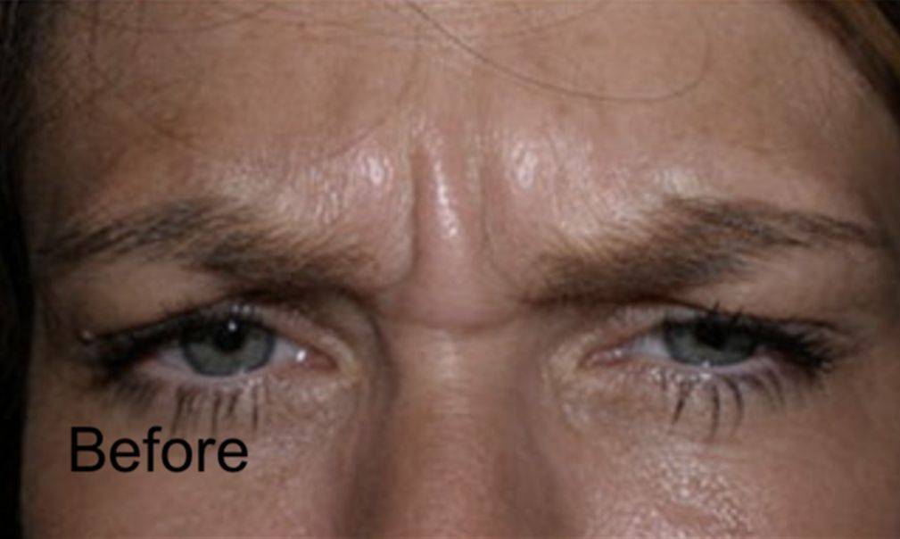 Neurotox to Get Rid of the Forehead Wrinkles Before