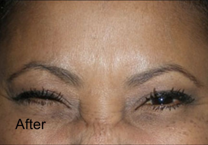 Treat Frown Lines With Botox After