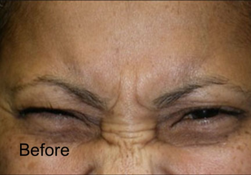 Treat Frown Lines With Neurotox Before