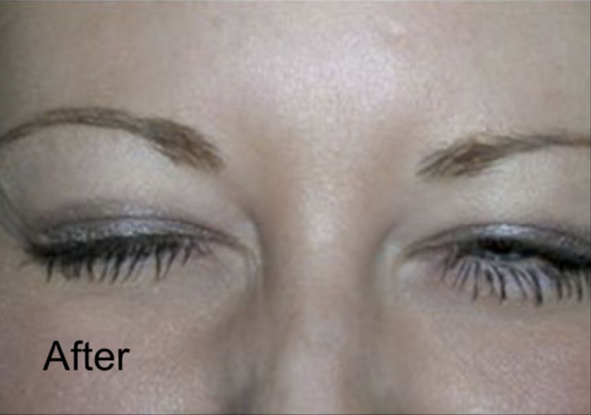 Botox for Frown Lines After
