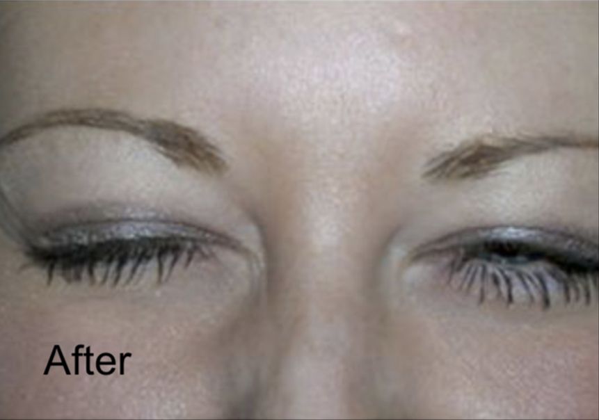 Neurotox for Frown Lines After