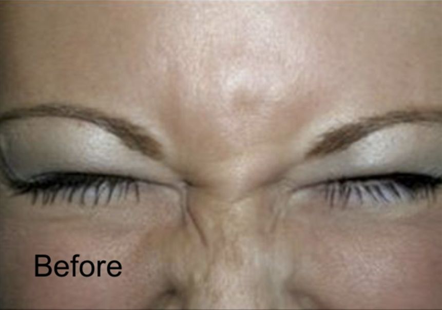 Botox for Frown Lines  Before