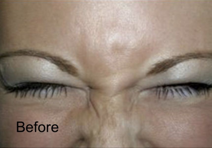Neurotox for Frown Lines  Before