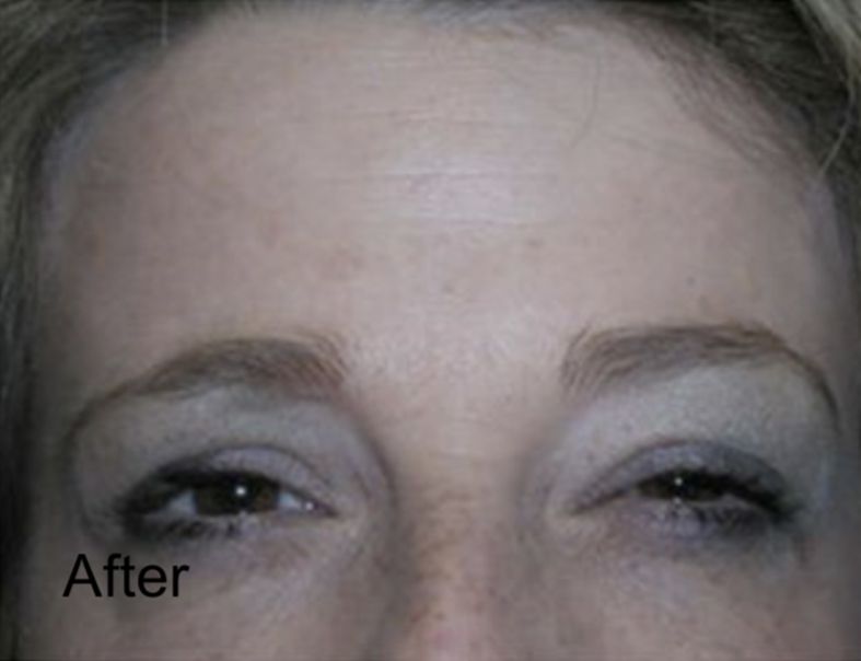 Botox for Frown Lines & Forehead Wrinkles After