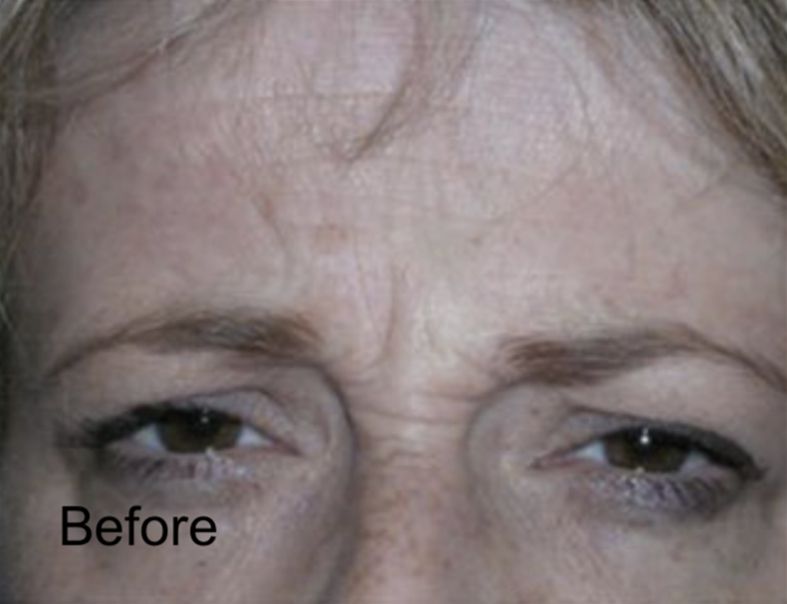 Neurotox for Frown Lines & Forehead Wrinkles Before
