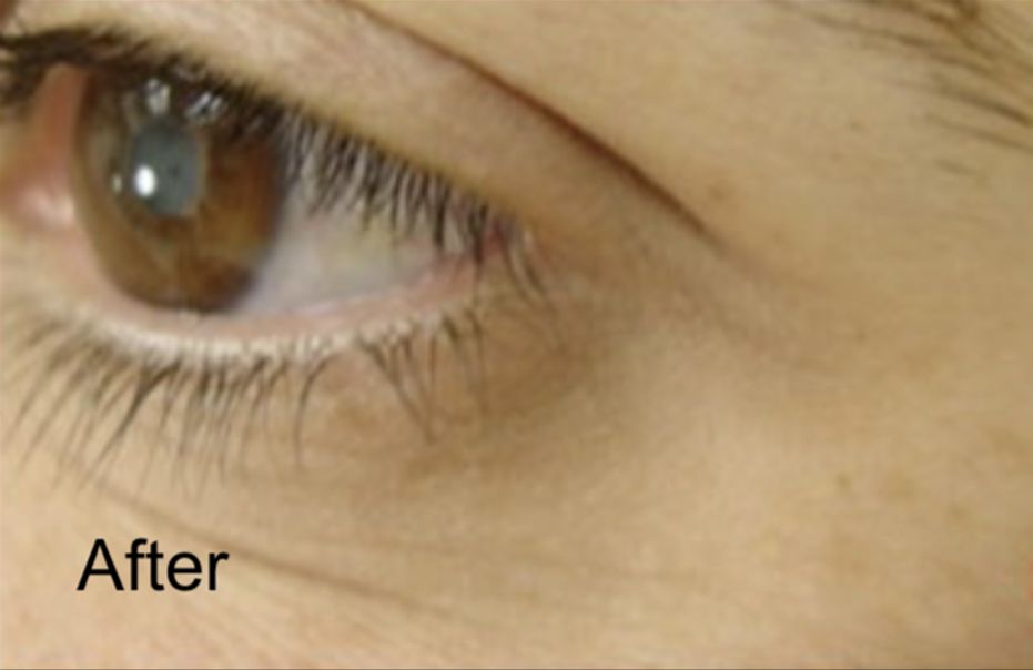 Neurotox to Get Rid of Crows Feet After