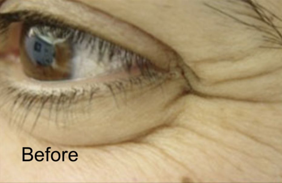 Neurotox to Get Rid of Crows Feet Before