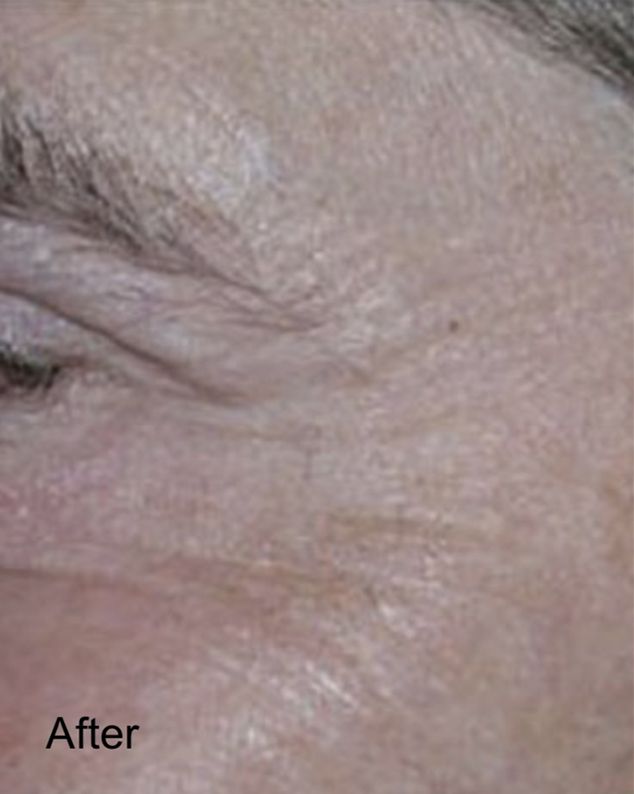 Reduced Visibility of Crow’s Feet with Botox After