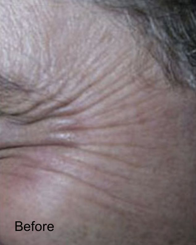 Reduced Visibility of Crow’s Feet with Botox Before
