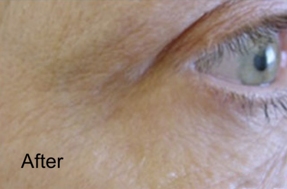Neurotox for Deep Wrinkles & Crow’s Feet After