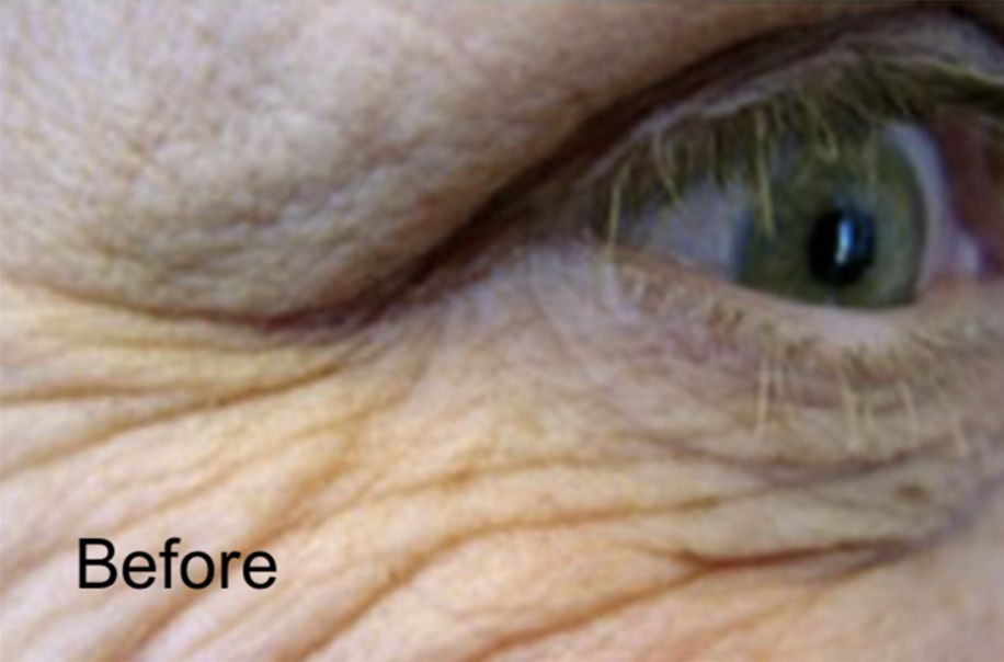 Botox for Deep Wrinkles & Crow’s Feet Before