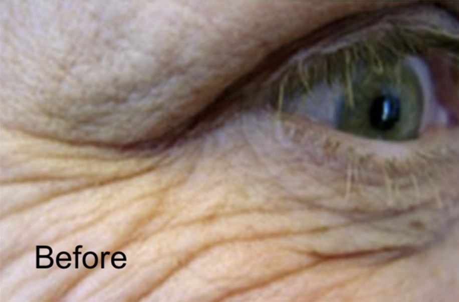 Neurotox for Deep Wrinkles & Crow’s Feet Before
