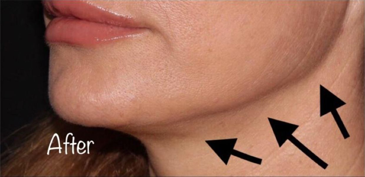 Neurotox For The ‘Lifted’ Neck Area After