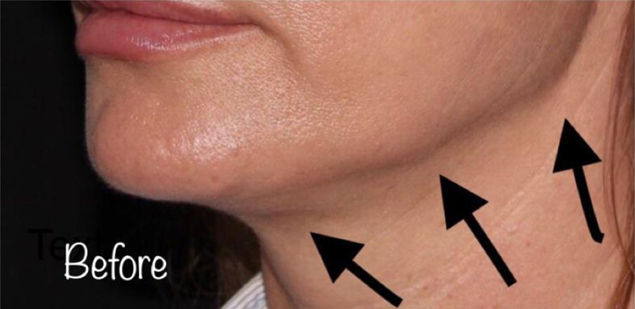 Botox For The ‘Lifted’ Neck Area Before