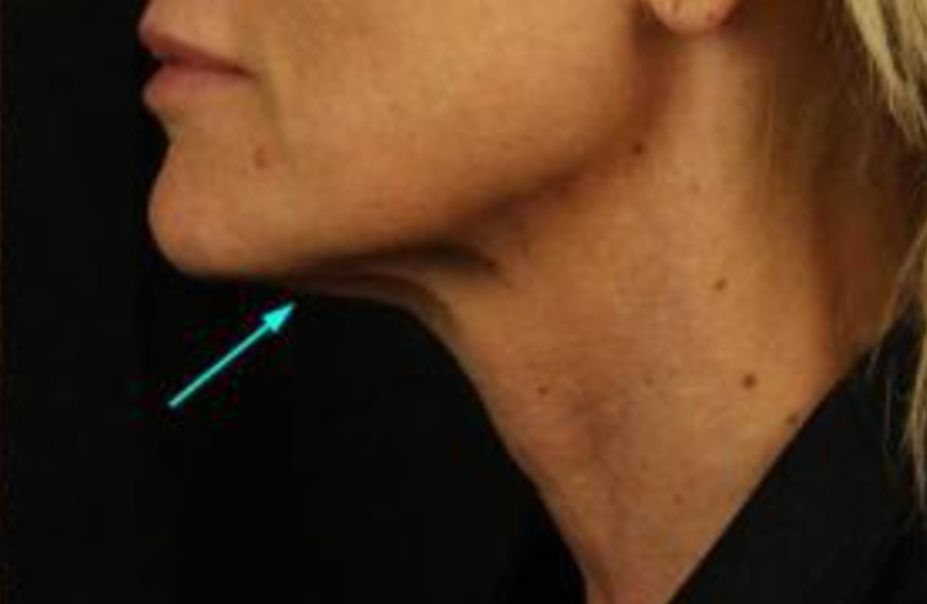 Neurotox for Turkey Neck After