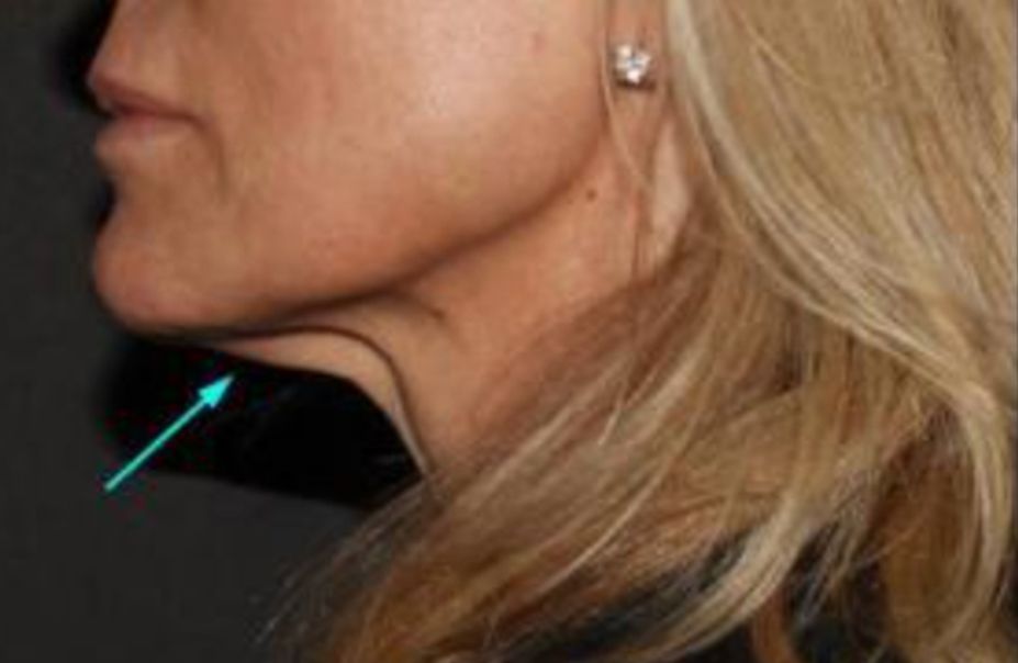 Neurotox for Turkey Neck Before