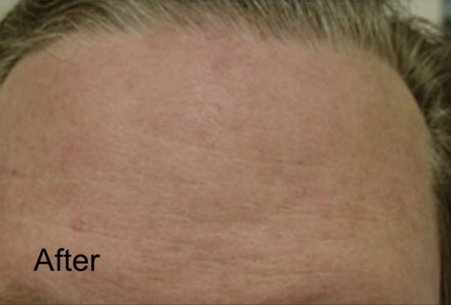 Neurotox for Forehead  After