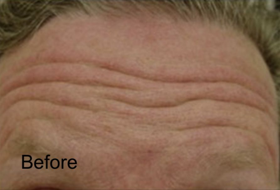 Botox for Forehead  Before