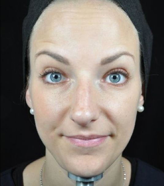 Baby Neurotox for Forehead Wrinkles After