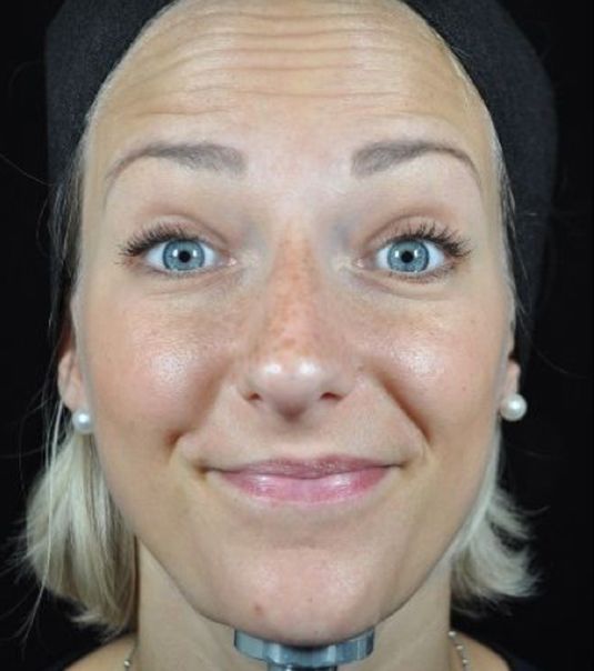 Baby Neurotox for Forehead Wrinkles Before