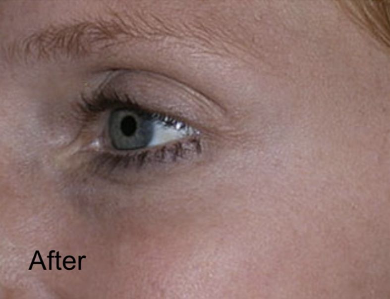 Neurotox Treatment for Crow