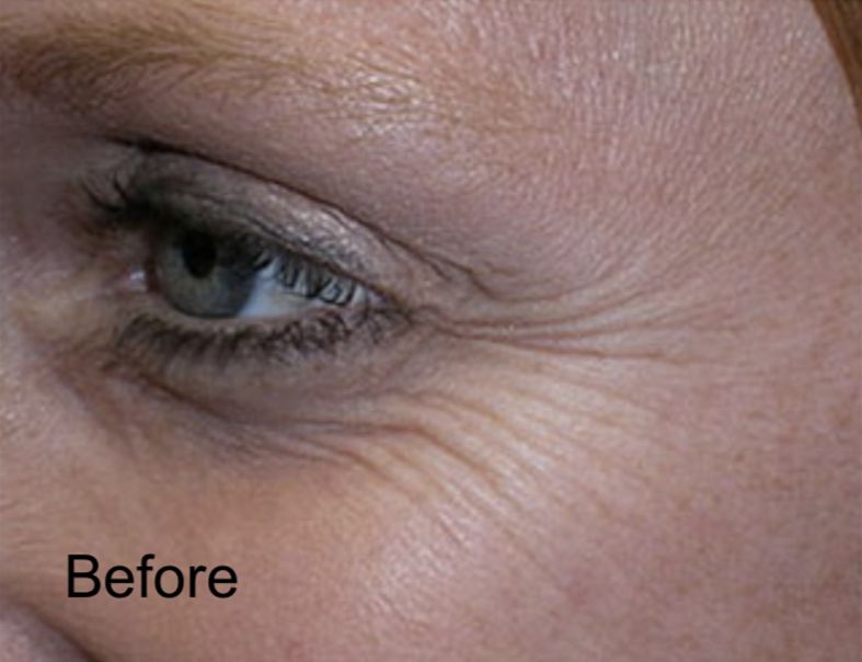 Neurotox Treatment for Crow