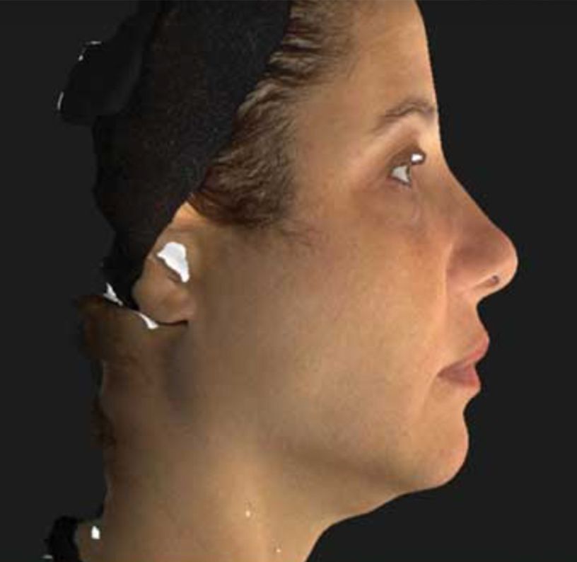 Nefertiti Neck Lift with Neurotox - After