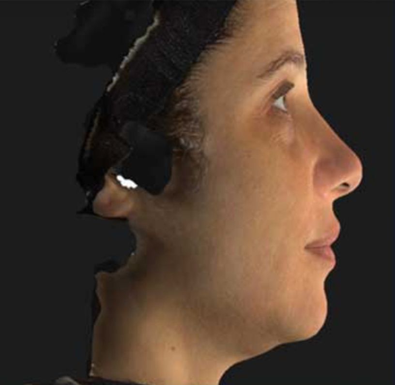 Nefertiti Neck Lift with Neurotox - Before