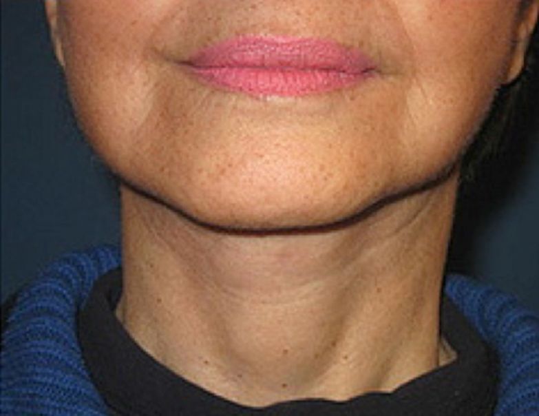 Neck Botox After