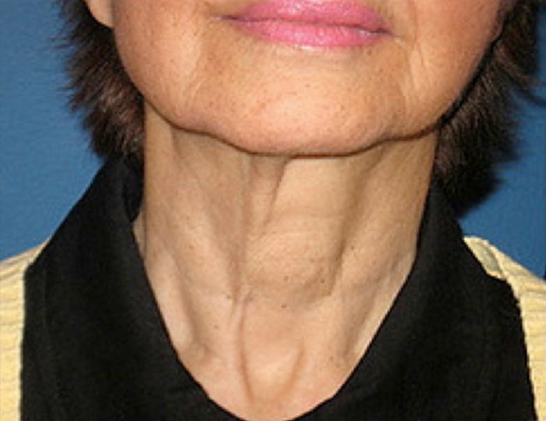 Neck Neurotox Before