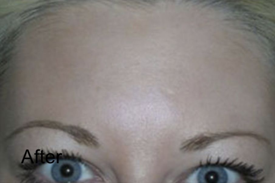 Forehead Wrinkles Reduction with Neurotox After