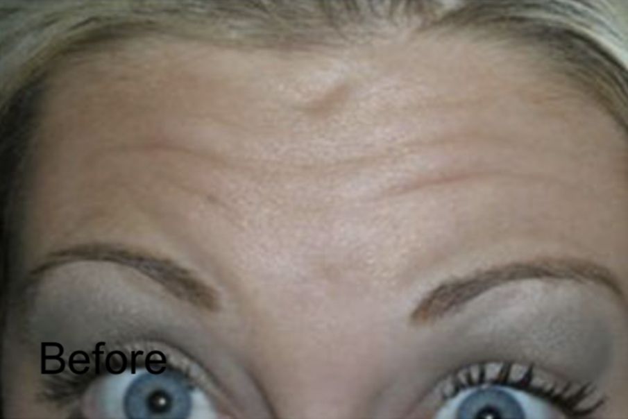 Forehead Wrinkles Reduction with Botox Before