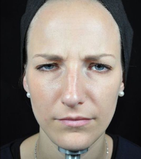 Baby Neurotox for Frown Lines After