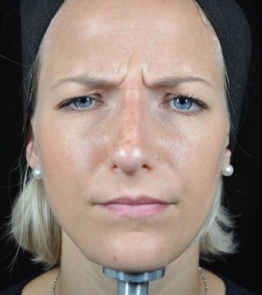 Baby Botox for Frown Lines Before