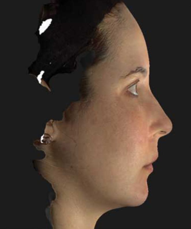 Nefertiti Lift Neurotox Treatment  After