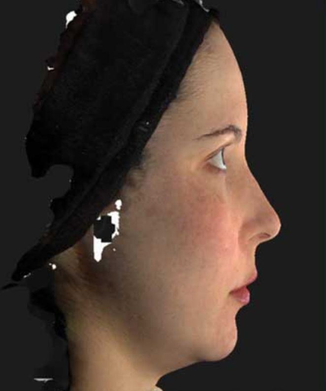 Nefertiti Lift Neurotox Treatment  Before