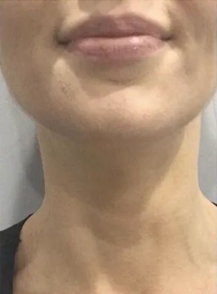 Botox Neck Lift After