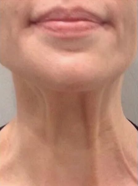 Botox Neck Lift Before